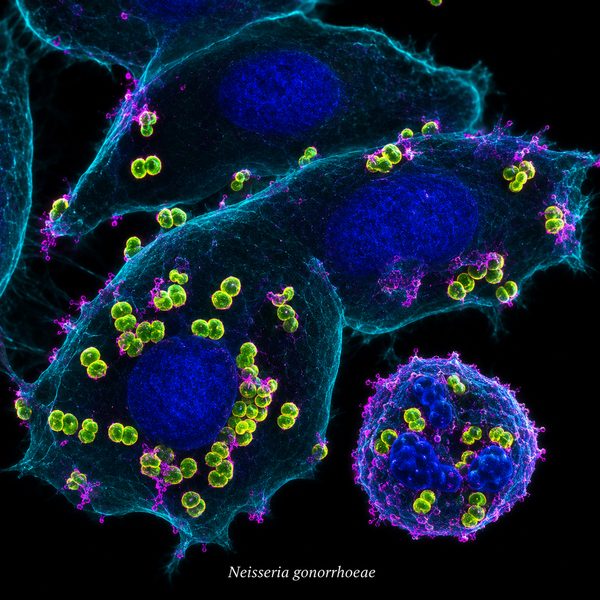 Gonorrhea — molecular fluorescence imaging