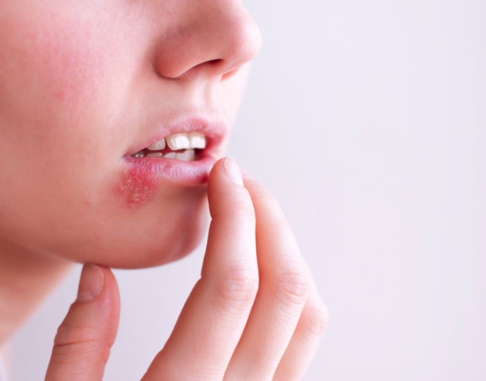 What Does Herpes Look Like on Your Lips? A Practical Guide for Patients Seeking Clear Answers