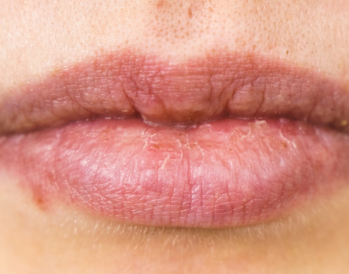 What Does Oral Herpes Look Like? A Clear Guide for Patients Who Are Unsure What They’re Seeing