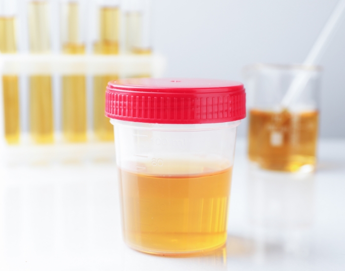 Blood in Urine (Pink or Reddish Urine): Causes, Testing, and When to Seek Help