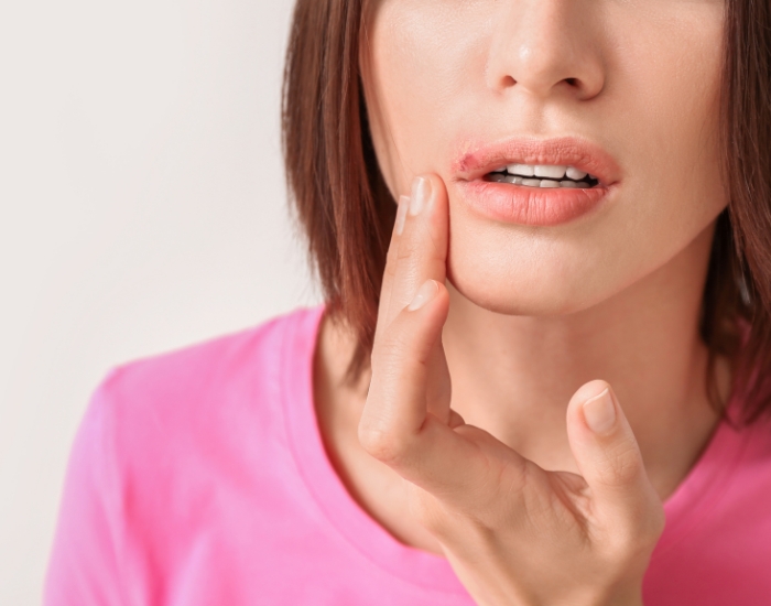 Herpes en la Garganta: Guía Completa Sobre Síntomas, Diagnóstico y Pruebas de Laboratorio