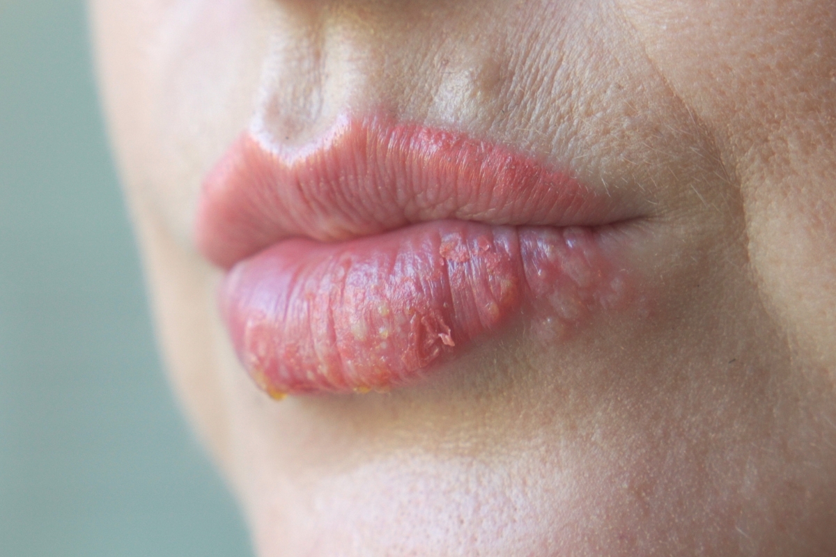 Cold sore vs pimple comparison image showing oral herpes and acne differences