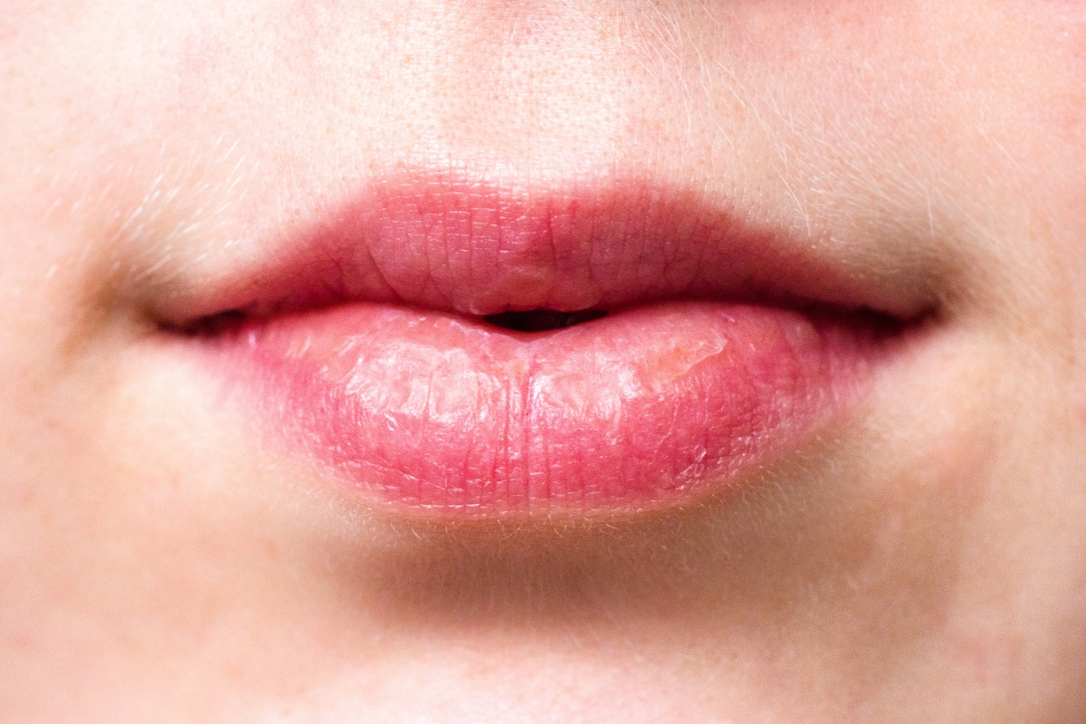 Cold sore healing stages showing crusting and oral herpes recovery