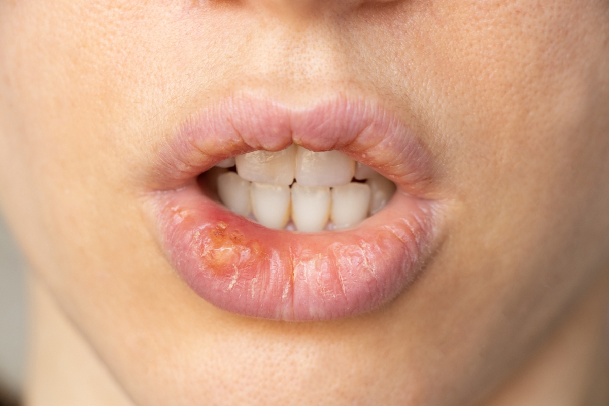 Herpes rash pictures showing HSV-1 cold sore symptoms and oral herpes blisters