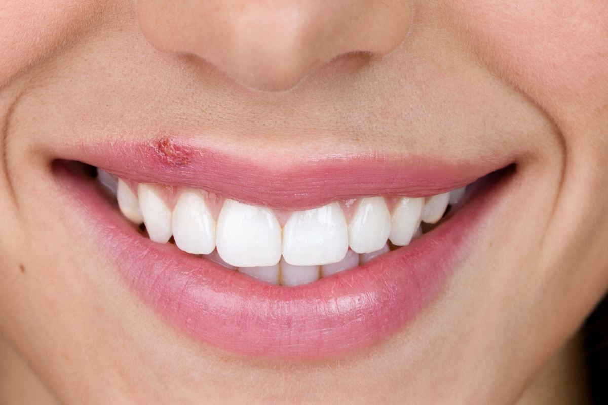 HSV-1 cold sore stages and oral herpes healing process