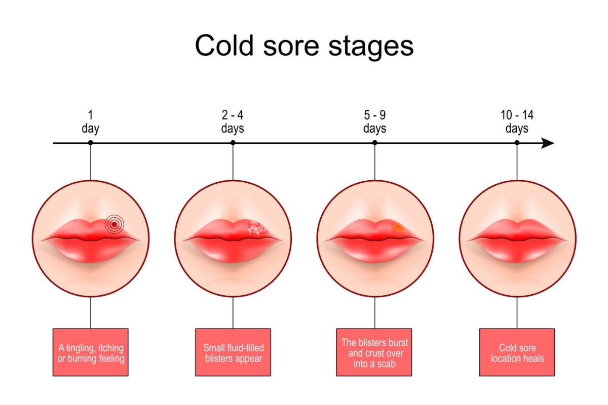HSV-1 stage 1 showing tingling lips and small blisters