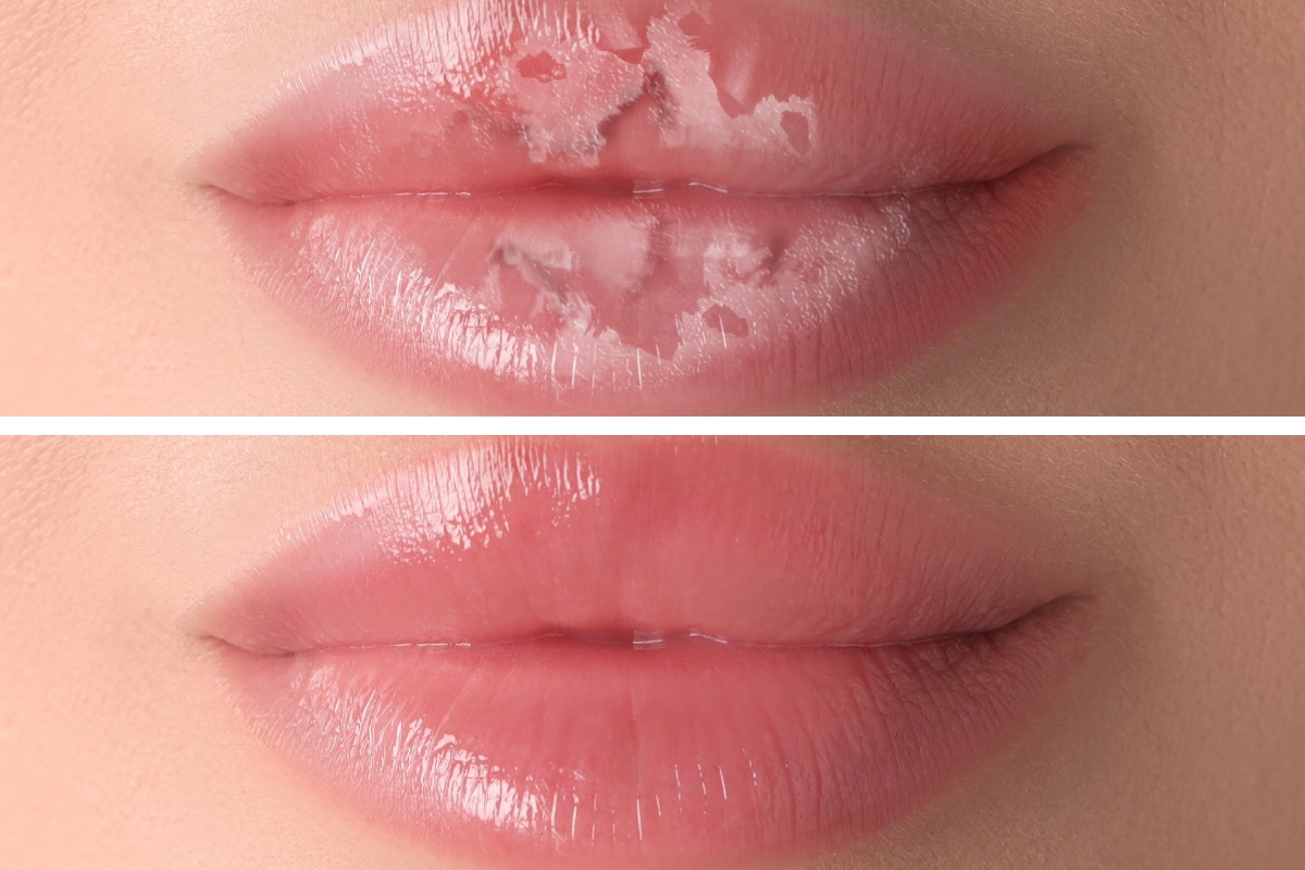 Lip blister healing stage and oral herpes recovery signs