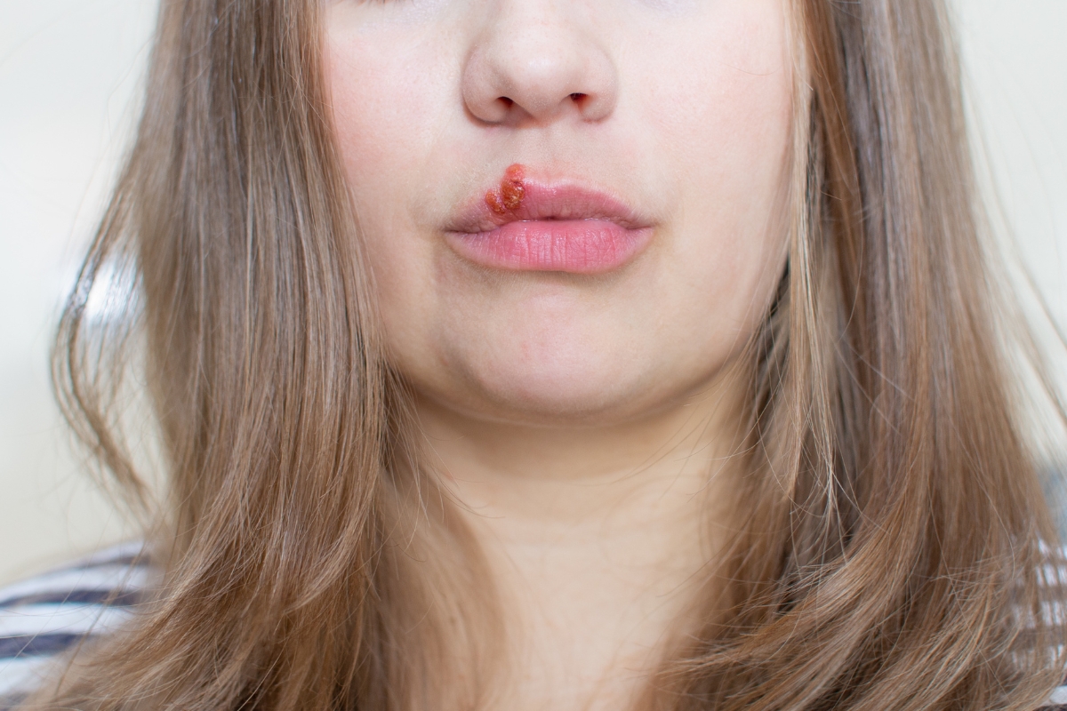 Oral herpes transmission risk and HSV-1 cold sores