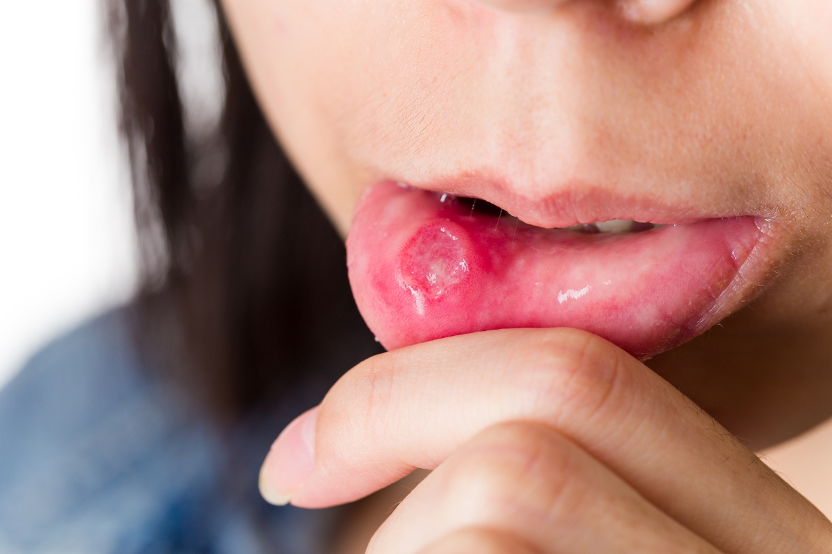 Oral herpes on lips with HSV-1 cold sore symptoms and blisters