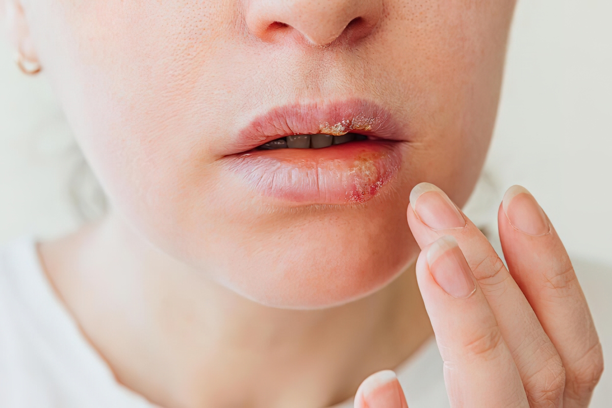 Oral herpes rash on lips with HSV-1 cold sore blisters