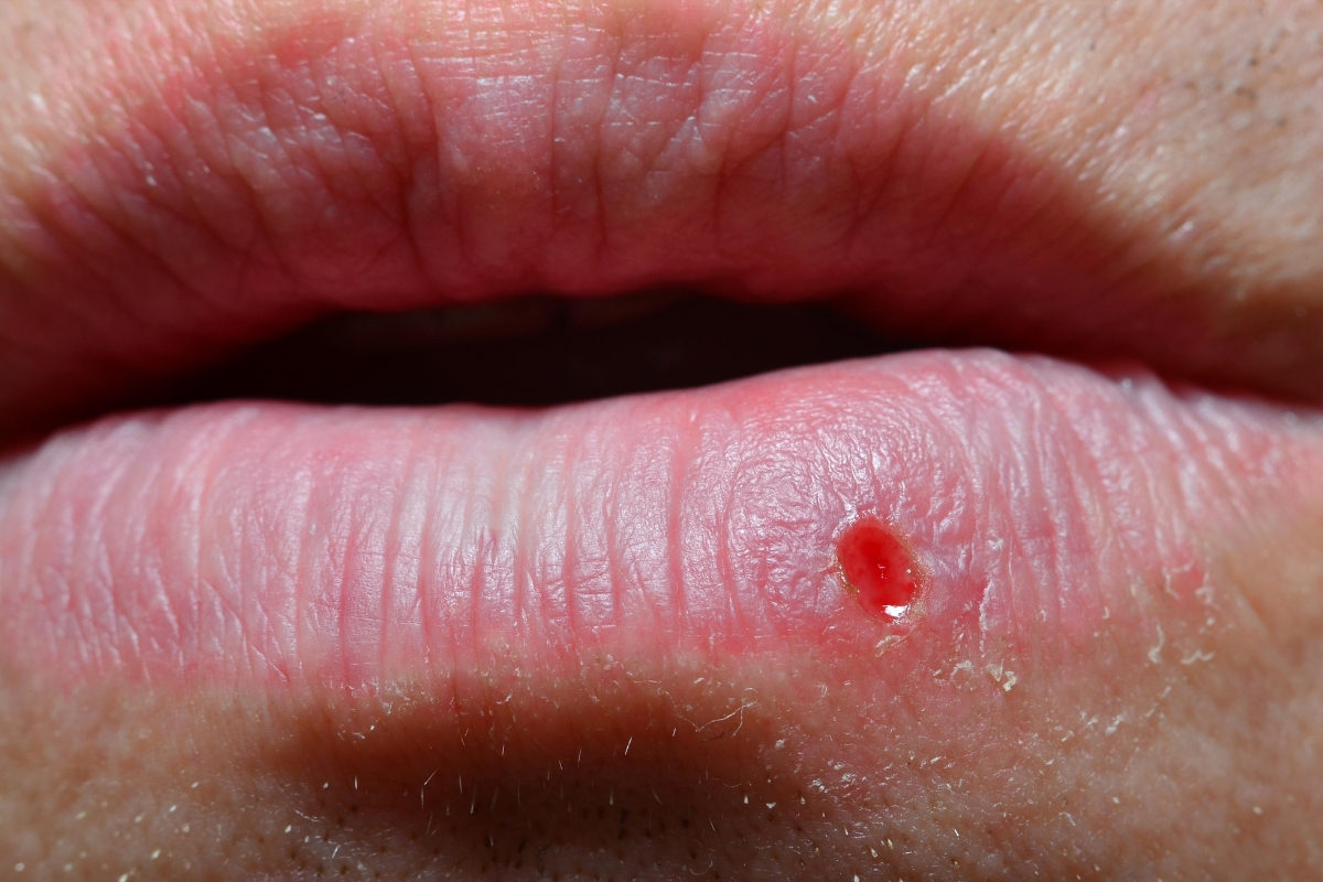 Oral herpes small blisters on lips and HSV-1 symptoms