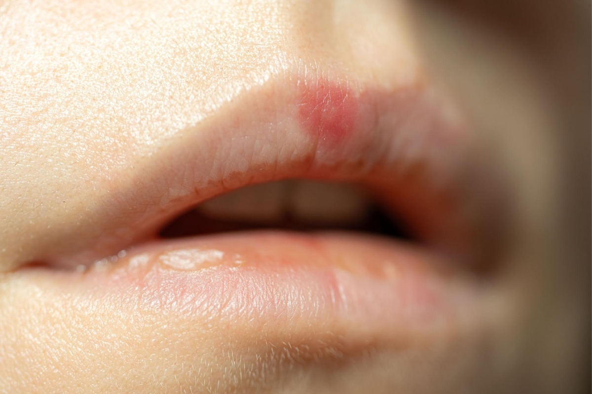 Tiny blisters on lips showing possible HSV-1 cold sore symptoms