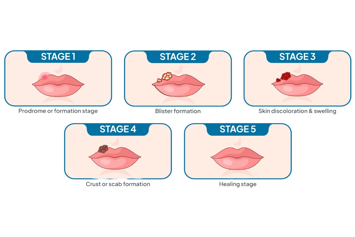 What healing herpes looks like during HSV-1 cold sore recovery